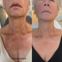 NECK LIFT CREAM. Интенсивный анти-эйдж крем для шеи и декольте с 6-ю видами растворимого Микроколлагена (коллагеновые нити) и 22-мя активными ингредиентами для клеточного омоложения, 50 гр