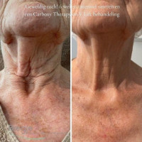 NECK LIFT CREAM. Интенсивный анти-эйдж крем для шеи и декольте с 6-ю видами растворимого Микроколлагена (коллагеновые нити) и 22-мя активными ингредиентами для клеточного омоложения, 50 гр
